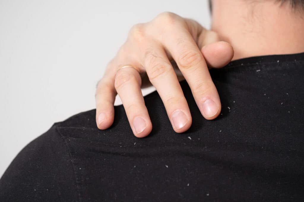 łupież na koszulce